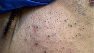 Sebum Filaments Removal | Korean Skincare Deep Cleansing