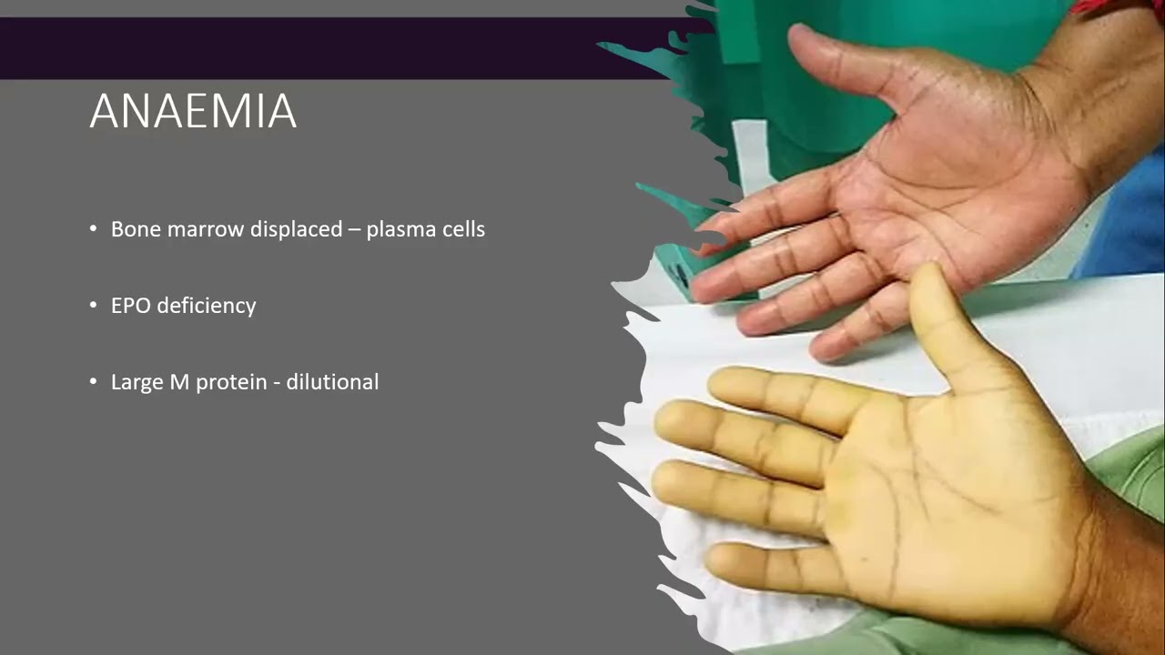 Myeloma - Best Care in 2026