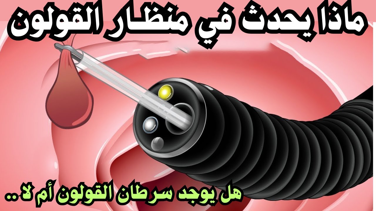 كل ما تحتاج معرفته عن منظار القولون  | تنظير القولون  | COLONOSCOPY .