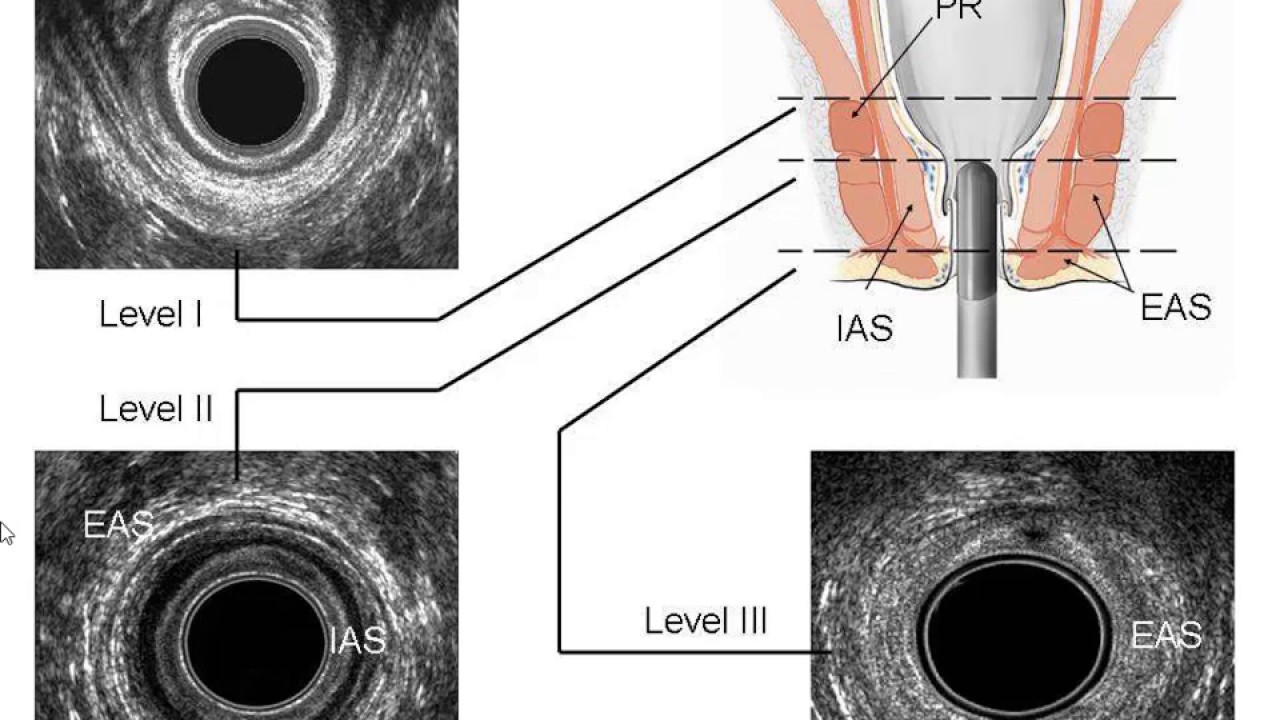 Diagnosis of Chronic Constipation What is new? YouTube
