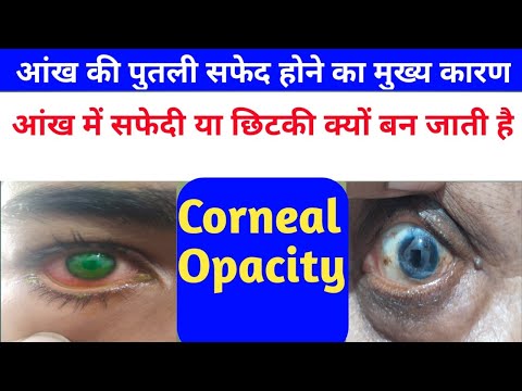 आंख की पुतली सफेद होने का मुख्य कारण।What Cause Corneal Opacity of Eye।Opacity Of Eye vision Opacity