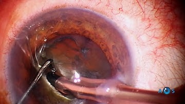 Expert Tips for Phaco in the Very Dense Cataract