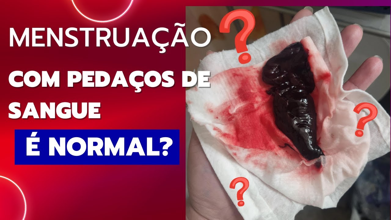 É normal sair um pedaço de carne na menstruação? 