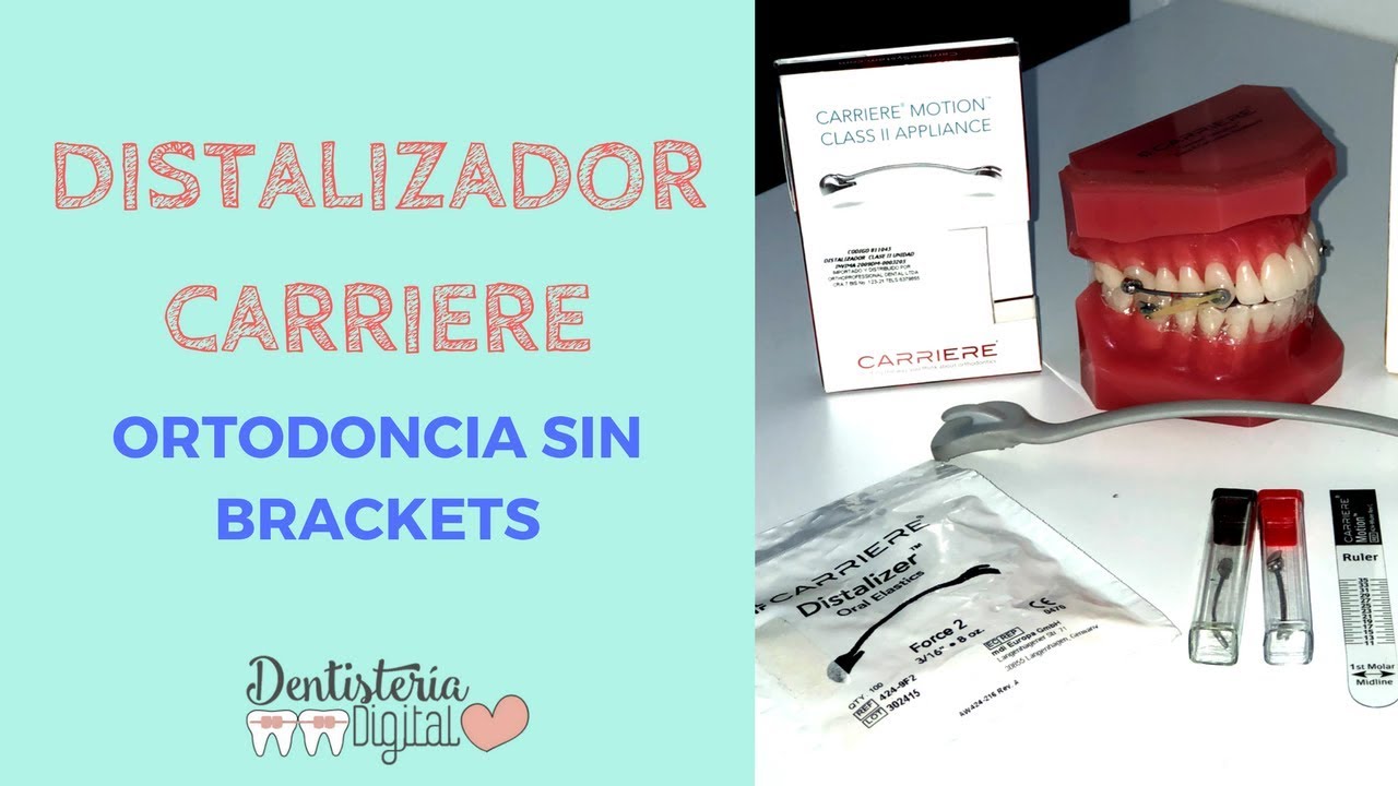 Distalizador de Carriere Carriere Motion para Maloclusiones Clases II y Clases III YouTube