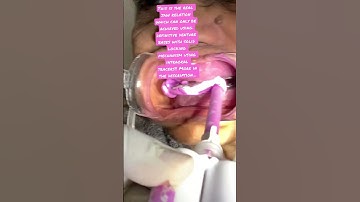 Definitive jaw relation using intraoral tracers. Sure shot way to centric records