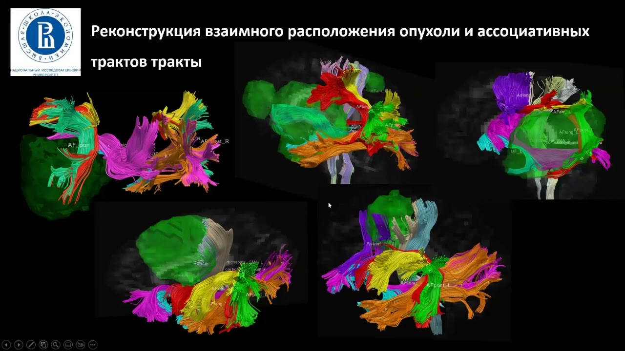 Школа молодых учёных: Яшин К.С. - Трансляционная нейроонкология