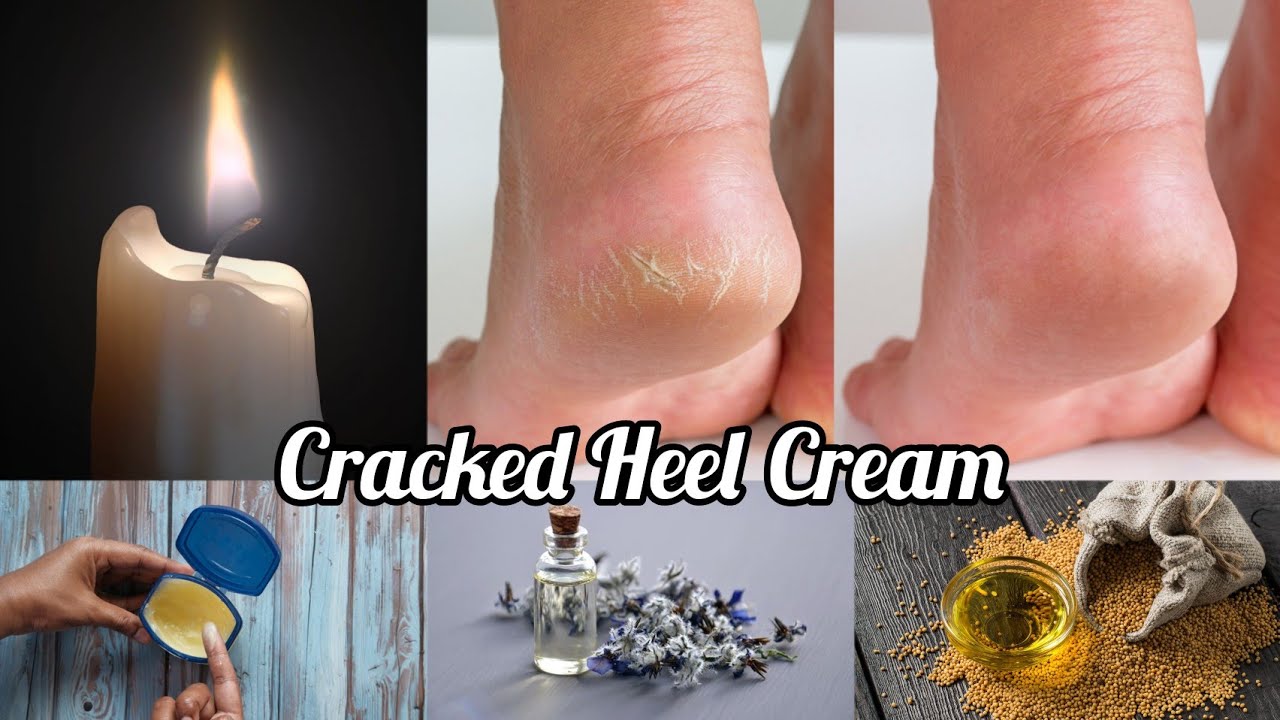 HealthBytes: Effective tips to tackle cracked heels at home