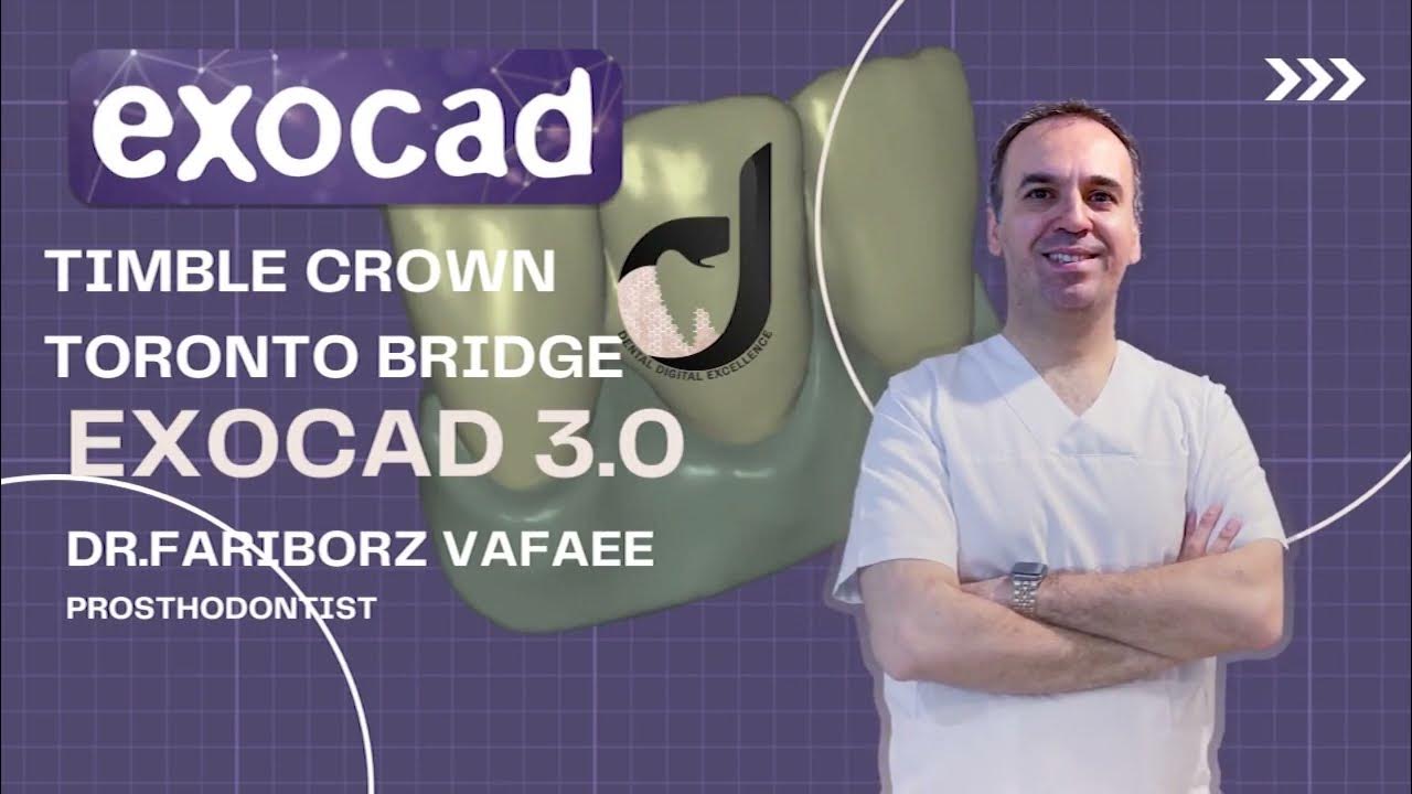 How to design a Toronto bridge (thimble crown ) step by step in exocad