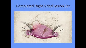 STS University Course 9: Atrial Fibrillation (Maze Procedure)