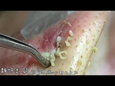 臉頰密集粉刺(Intensive acne on cheeks)-Taiwan New Taipei City-大台北清粉刺最乾淨