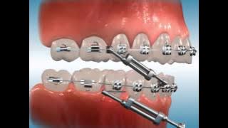 Twin Force® Bite Corrector for Class II Correction