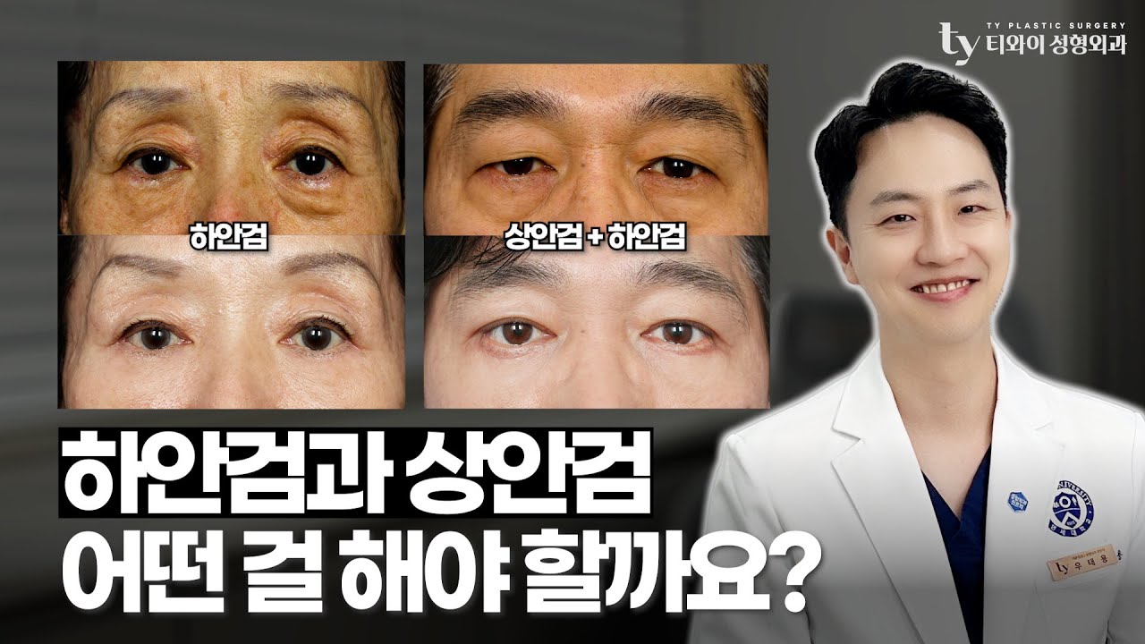 상안검과 하안검 중 고민이라면?ㅣ하안검 수술의 효과ㅣ하안검 수술의 부작용ㅣ중안면거상도 같이하면 좋다?ㅣ성형외과 전문의 우태용 ...