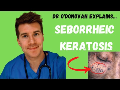 Videó: Seborrheicus Keratózis: Kockázatok, Diagnózis és Kezelés