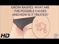 Solving The Mystery Of Groin Rashes What You Need To Know Solving The Mystery Of Groin Rashes What You Need To Know