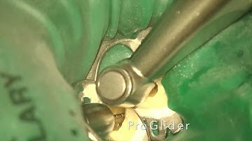 Protaper Next Case I - Dr. Tomas Lang