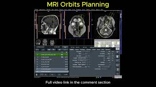MRI of Orbits Planning #mri #radiology #radiographer #radtech #xray #ctscan #medicalimaging #mriscan