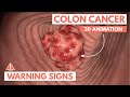 5 warning signs of colon cancer  3d animation