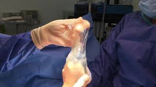 Dr. Linder Removes 32 Year Old Ruptured Silicone Gel Breast Implant