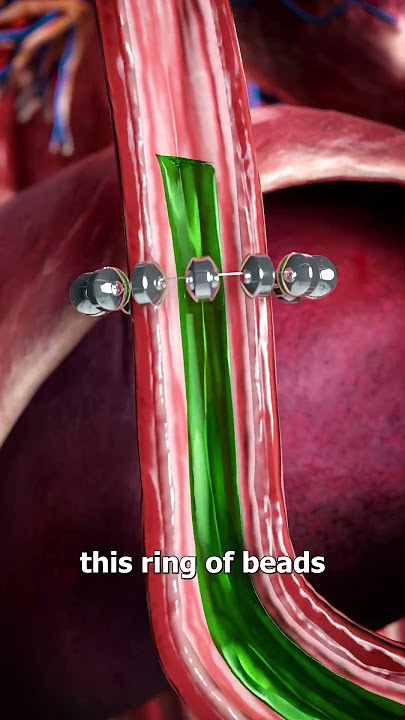 How Beads Stop Acid Reflux 😨