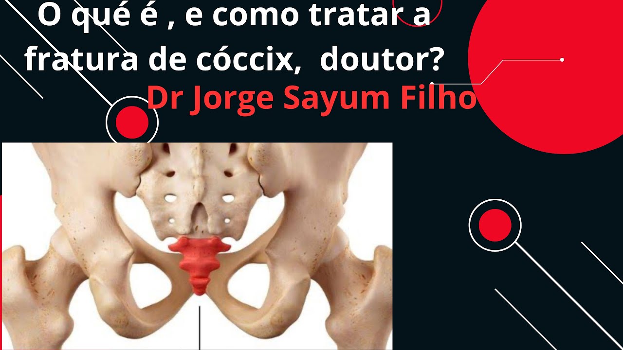 Quebrei o meu cóccix! E agora Dr? O que eu faço?