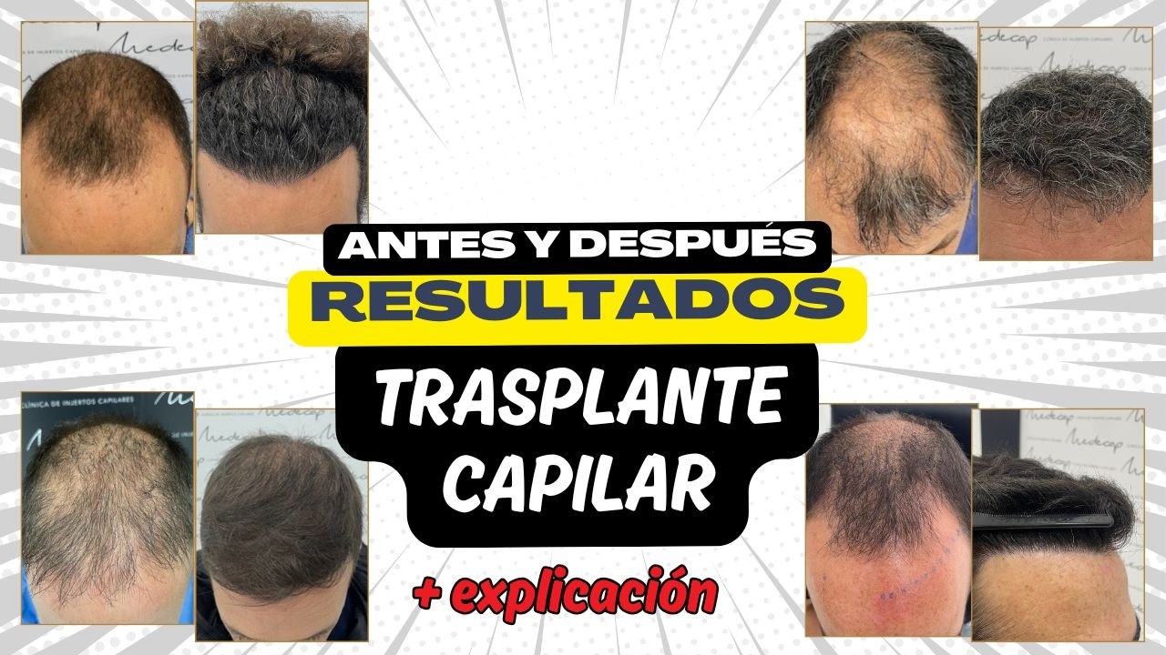 Casos reales de TRASPLANTE CAPILAR con Dra. ANA BELEN RODRIGUEZ/Lo que debes saber antes de operarte