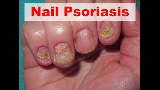 Nail Psoriasis - What Exactly is Nail Psoriasis