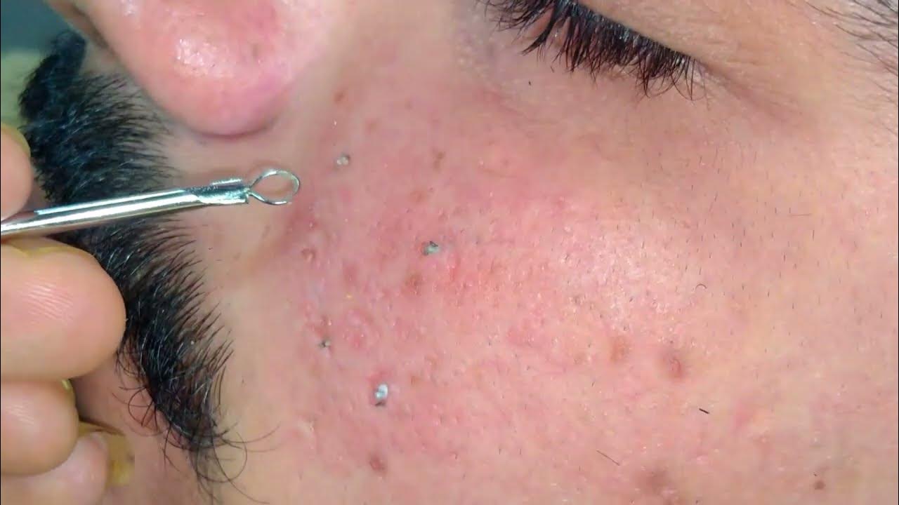 Ga Spa Videos For Removal Of Blackheads blackheads removal sac dep spa 2024 | How to remove blackheads from