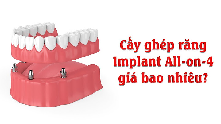 Cấy ghép răng implant bao nhiêu tiền năm 2024