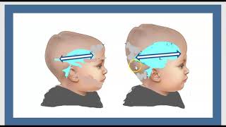 Types Chiari Malformations Syringomyelia Syrinx  Syndrome CSF Treatment Surgery Hydrocephalus 3minut