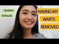 VLOG 17: MY WARTS REMOVAL PROCEDURE PROCESS - Updates and Results | Awit Garcia