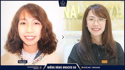 NIỀNG RĂNG ĐÃ THAY ĐỔI CUỘC SỐNG NHƯ NÀO ? BẤT NGỜ SAU 2 NĂM NIỀNG RĂNG