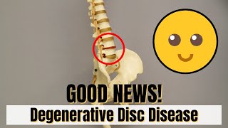 Good News!! If diagnosed with DDD (Degenerative Disc Disease) Must Know This!!