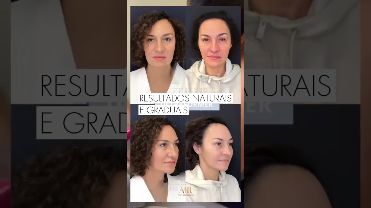 Ultraformer MPT Day — Rejuvenesça Sem Cirurgia! 12 de Abril na Aesthetic Center por Dra. Aline Rocha