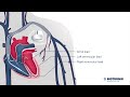 Cardiac Resynchronization Therapy, CRT (Medical Animation)