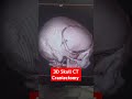 3D reconstruction of Head | Craniectomy done for Brain tumor removal #ctscan #radiology #mri #mrcp