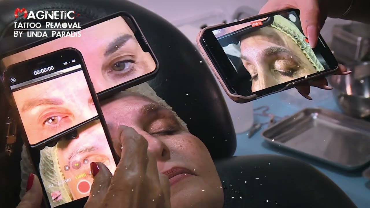 Пример из практики удаления татуажа бровей | Рабочие сеансы, извлечение чернил и результаты