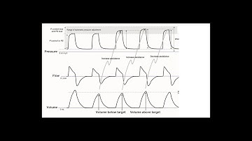Setting up Pressure Support with Safety Tidal Volume (PS/SVt)