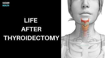 Life after Thyroidectomy