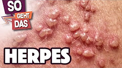 In der genitalis scheide herpes Herpes genitalis