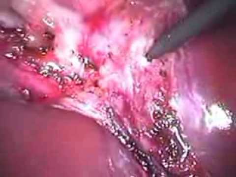 Laparoscopic Cholecystectomy (unedited-14)- Modified Needlescopic Cholecystectomy