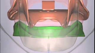 Massad Tray Sizing for Mandibular Impression