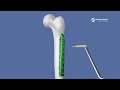 Fracture Col Du Fémur Et Trochanter Chirurgie Ostéosynthèse Par Vissage DHS Dr Simon Tournemine Fracture Col Du Fémur Et Trochanter Chirurgie Ostéosynthèse Par Vissage DHS Dr Simon Tournemine