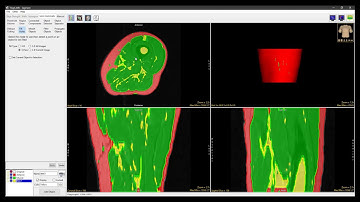 Analyze 14.0 - Segment: Using Fill Holes to Segment Objects