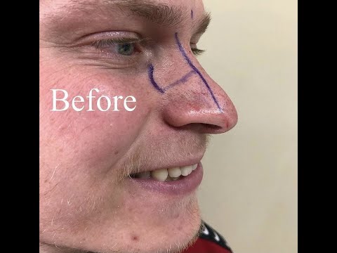 Patient testimonial video for a rhinoplasty with dr tas