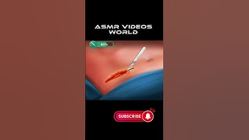 ASMR appendix removing surgery: Best animation #asmr #animation #surgery #shorts #youtubeshorts