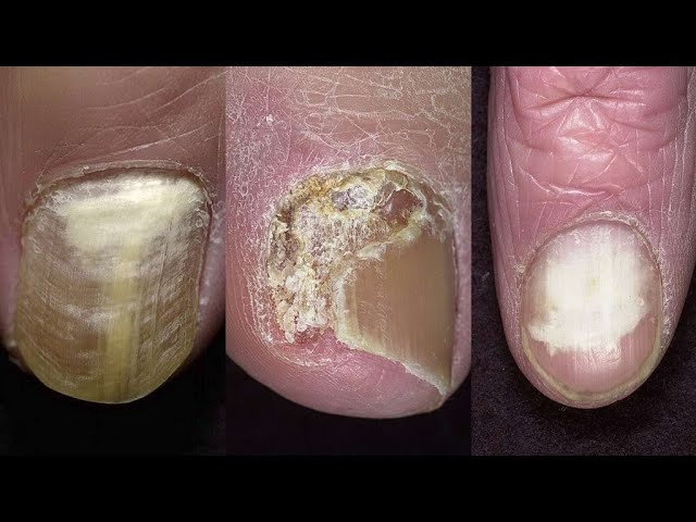 ОНИХОМИКОЗ и ОНИХОДИСТРОФИЯ: В чём отличия?