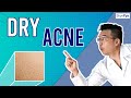 How To Treat Dry Skin + Acne (Dry Acne) | 5 Tips To Follow