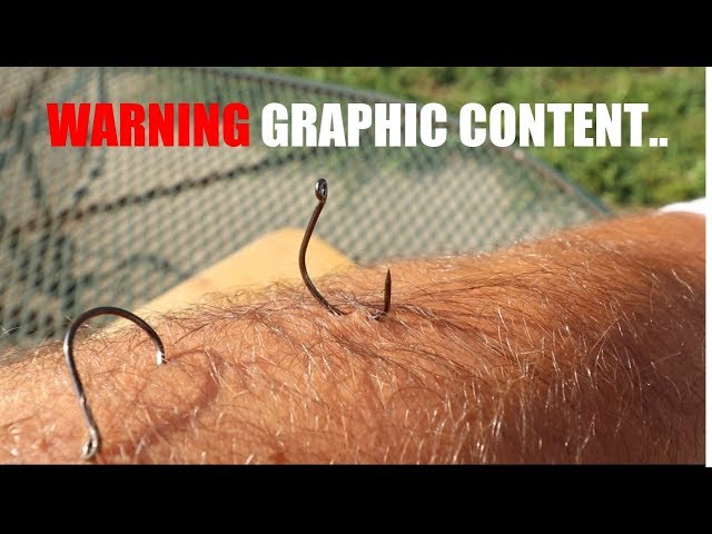 Top 3 Best Ways To Remove Fishing Hooks (GRAPHIC CONTENT) 