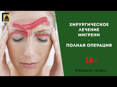 Хирургическое лечение мигрени