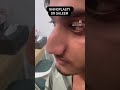 Rhinoplasty at best cost in Pakistan